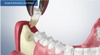 Quá trình phẫu thuật nhổ răng khôn mọc lệch?
