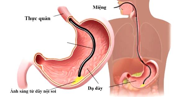 NỘI SOI DẠ DÀY, KHÓA 13