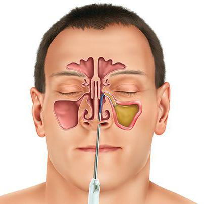 Tại sao kết quả nội soi tai mũi họng quan trọng trong việc chẩn đoán và điều trị các bệnh lý tai mũi họng?
